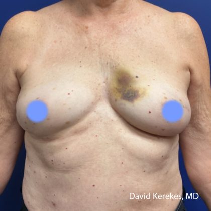 Breast Reconstruction Before & After Patient #5055
