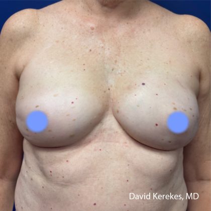 Breast Reconstruction Before & After Patient #5055