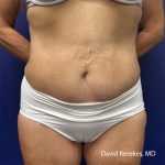Tummy Tuck Before & After Patient #5065