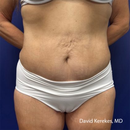 Tummy Tuck Before & After Patient #5065