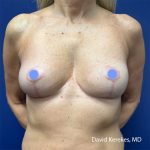 Cosmetic Breast Revisions Before & After Patient #5064
