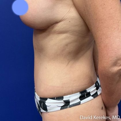 Tummy Tuck Before & After Patient #5032