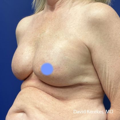 Breast Reconstruction Before & After Patient #5054