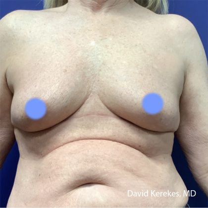 Breast Reconstruction Before & After Patient #5054