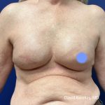 Breast Reconstruction Before & After Patient #5054