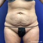 Tummy Tuck Before & After Patient #5031