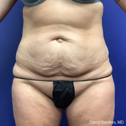 Tummy Tuck Before & After Patient #5031