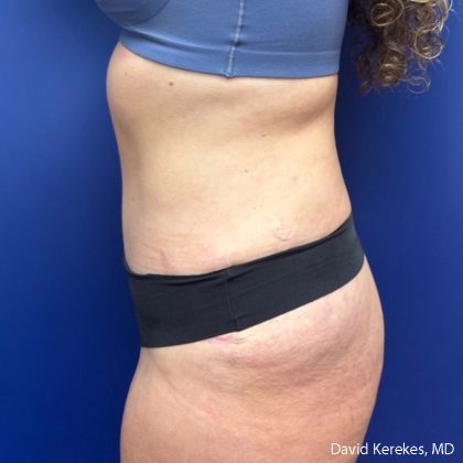Tummy Tuck Before & After Patient #5031