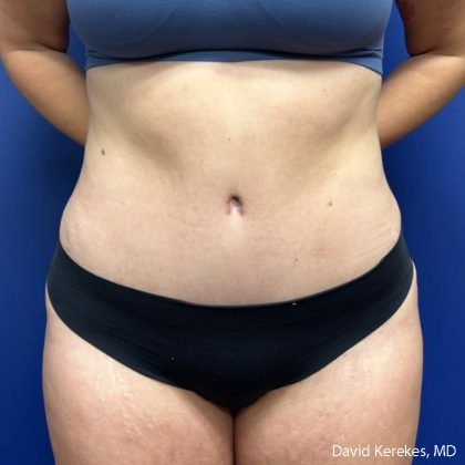 Tummy Tuck Before & After Patient #5031