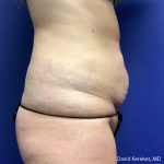 Tummy Tuck Before & After Patient #5031