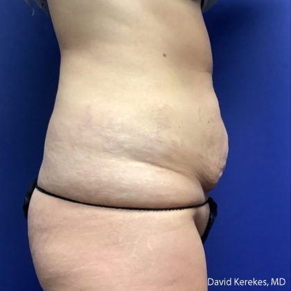 Tummy Tuck Before & After Patient #5031
