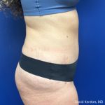 Tummy Tuck Before & After Patient #5031