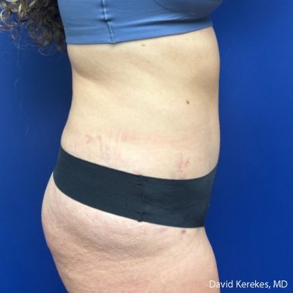 Tummy Tuck Before & After Patient #5031