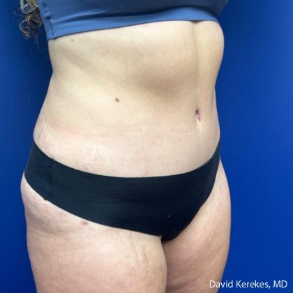 Tummy Tuck Before & After Patient #5031