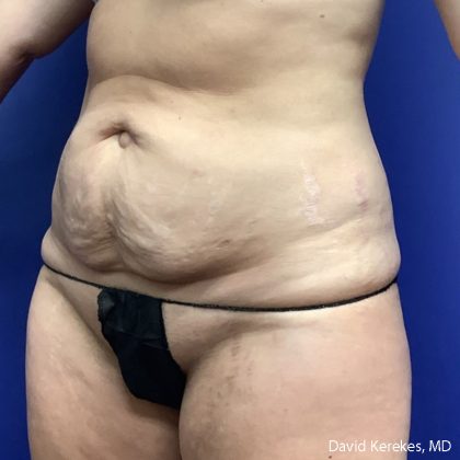 Tummy Tuck Before & After Patient #5031
