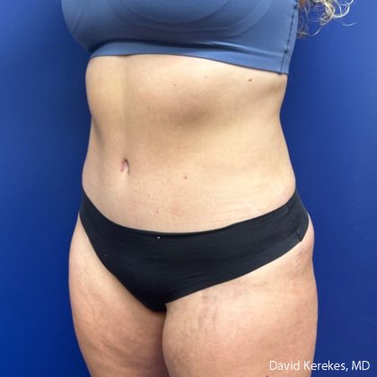Tummy Tuck Before & After Patient #5031