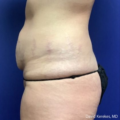Tummy Tuck Before & After Patient #5031
