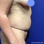 Tummy Tuck Before & After Patient #5032