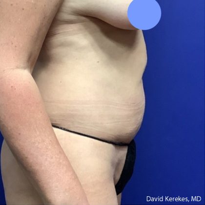 Tummy Tuck Before & After Patient #5032