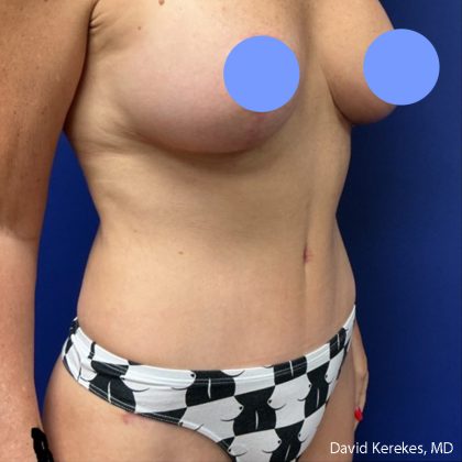 Tummy Tuck Before & After Patient #5032