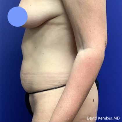 Tummy Tuck Before & After Patient #5032