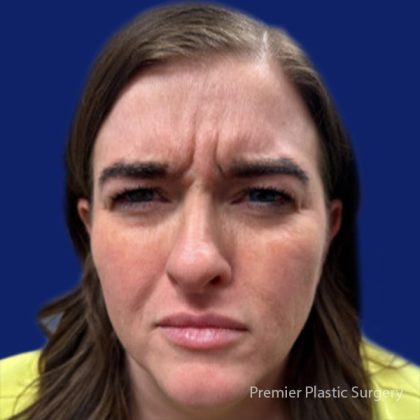 Botox Before & After Patient #5088