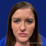 Botox Before & After Patient #5088