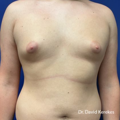 Gynecomastia Before & After Patient #5186