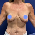 Breast Reconstruction Before & After Patient #5128