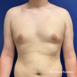 Gynecomastia Before & After Patient #5186