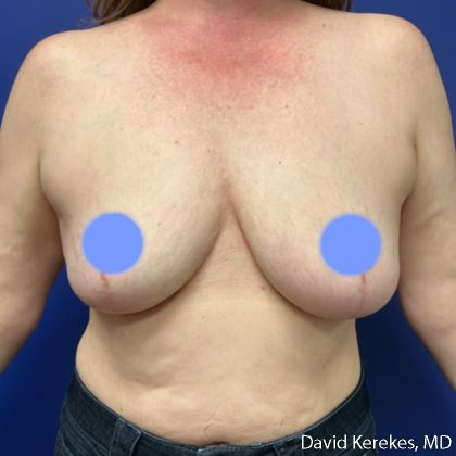 Breast Reconstruction Before & After Patient #5129