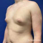 Gynecomastia Before & After Patient #5186