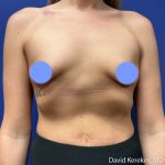 Breast Lift with Implants Before & After Patient #5140