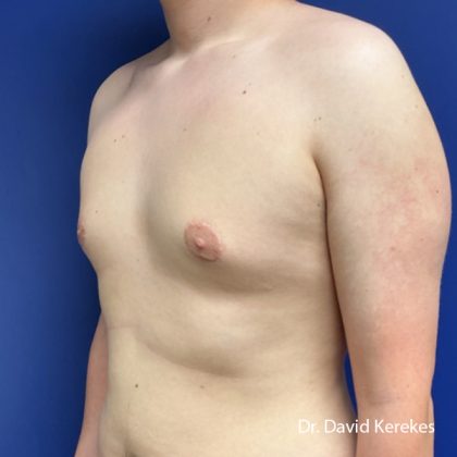 Gynecomastia Before & After Patient #5186