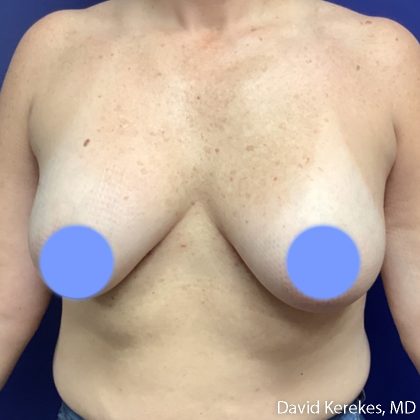 Breast Lift with Implants Before & After Patient #5139
