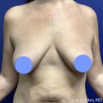 Breast Lift with Implants Before & After Patient #5138
