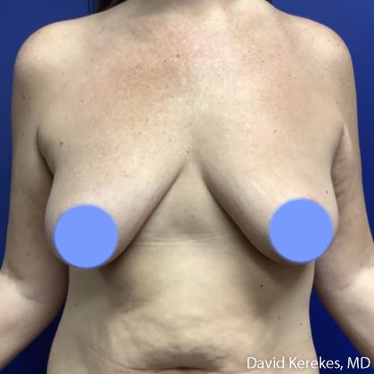 Breast Lift with Implants Before & After Patient #5138