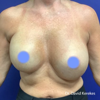 Breast Reconstruction Before & After Patient #5185