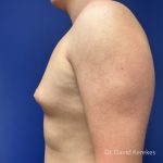 Gynecomastia Before & After Patient #5186