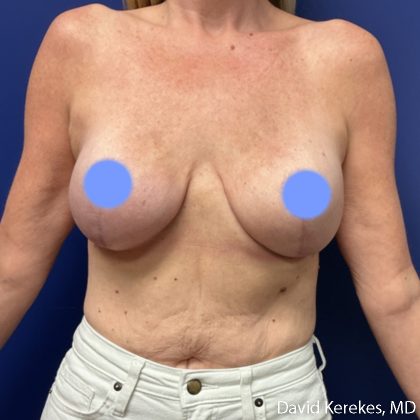 Breast Reconstruction Before & After Patient #5128