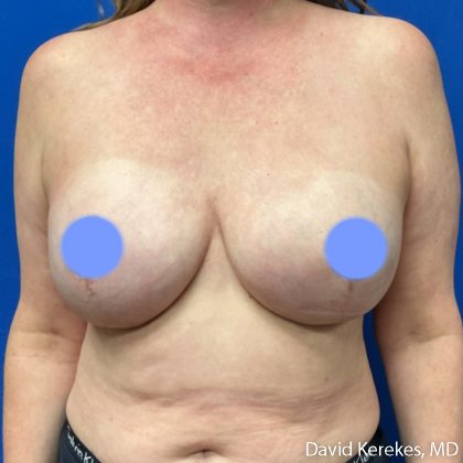 Breast Reconstruction Before & After Patient #5129