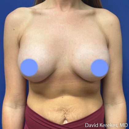 Breast Lift with Implants Before & After Patient #5140
