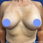 Breast Lift with Implants Before & After Patient #5139
