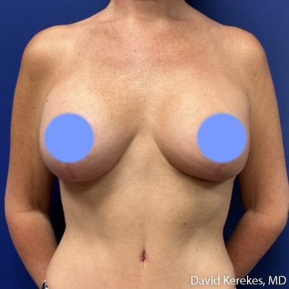 Breast Lift with Implants Before & After Patient #5138