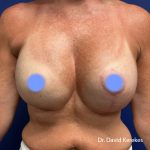 Breast Reconstruction Before & After Patient #5185