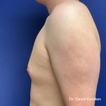 Gynecomastia Before & After Patient #5186