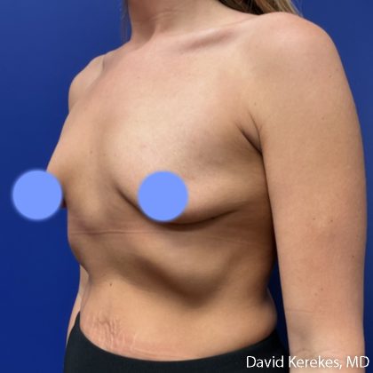 Breast Lift with Implants Before & After Patient #5140