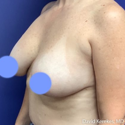 Breast Lift with Implants Before & After Patient #5139