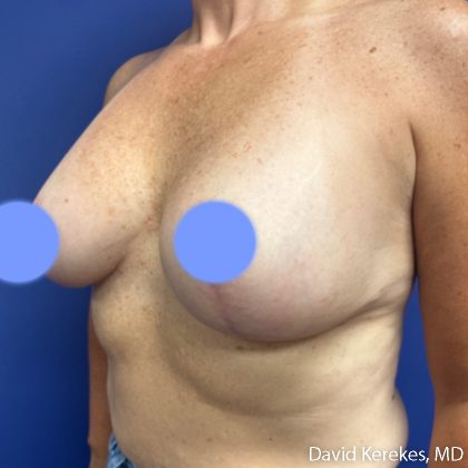 Breast Lift with Implants Before & After Patient #5139