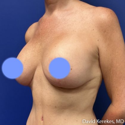 Breast Lift with Implants Before & After Patient #5138